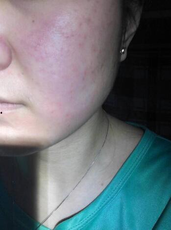 吃瓜过敏嗓子痒,揭秘过敏源与应对策略